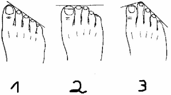 网传人类脚趾长度分三种"希腊脚"专出美女(图)
