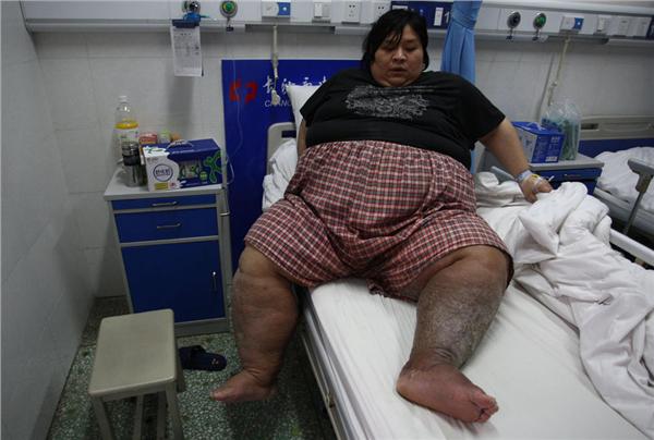 长沙35岁男子体重400多斤全身浮肿溃烂如同活死人
